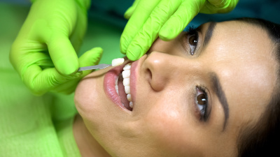 dental-veneers-green-valley-sahuarita