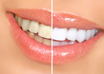 green-valley-Sahuarita-teeth-whitening